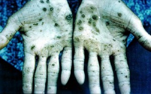 A common symptom of arsenic poisoning. For illustrative purposes only.