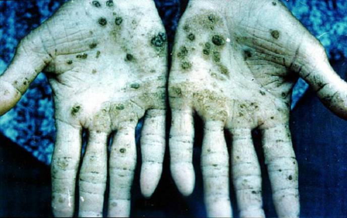 A common symptom of arsenic poisoning. For illustrative purposes only.