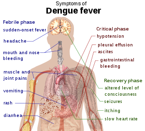 300px-Dengue_fever_symptoms1